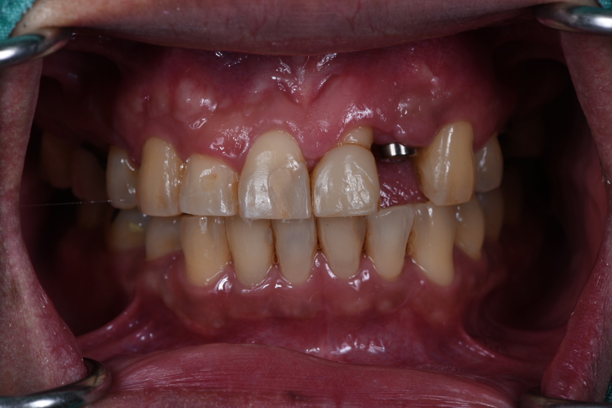 LINE_ALBUM_Implant+ceramic veneer คุณนราฤทธิ์_241020_1