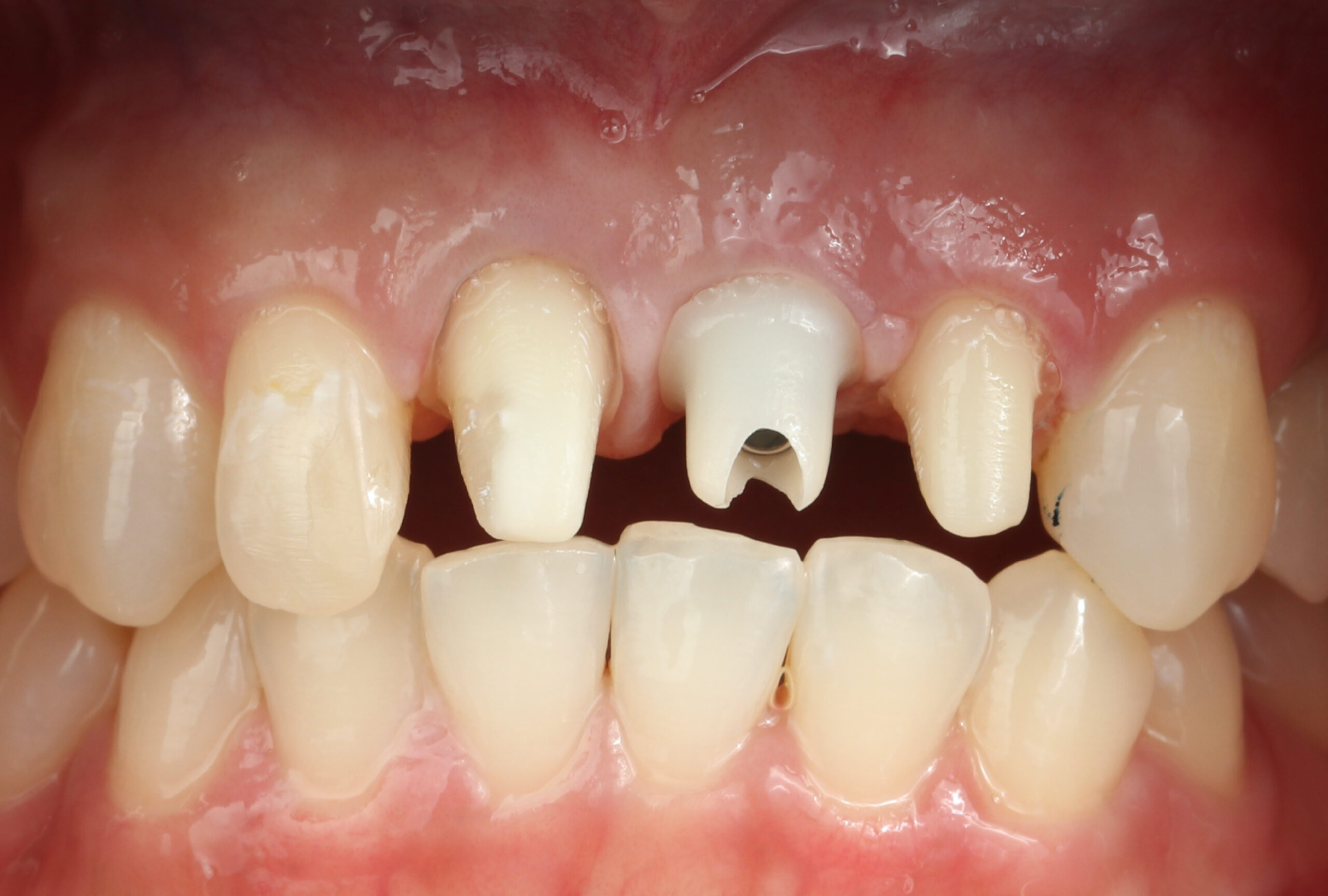 implant2